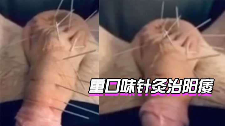 针灸治阳痿你想试下吗封面图